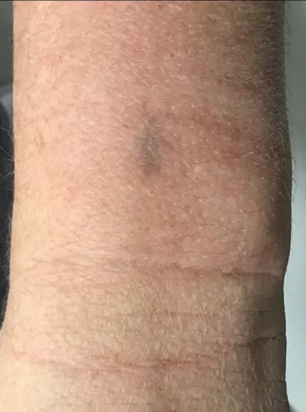Laser tattoo removal, wrist, after