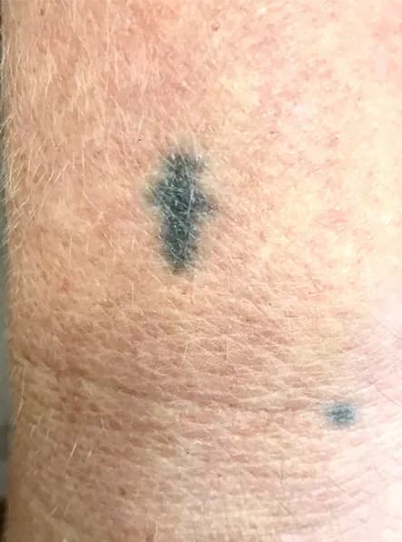 Laser tattoo removal, wrist, before