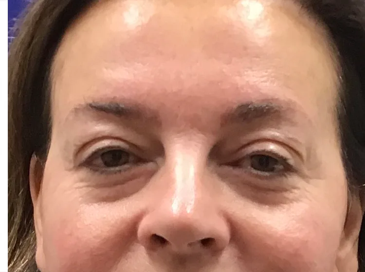 Eyebrow tattoo removal, after