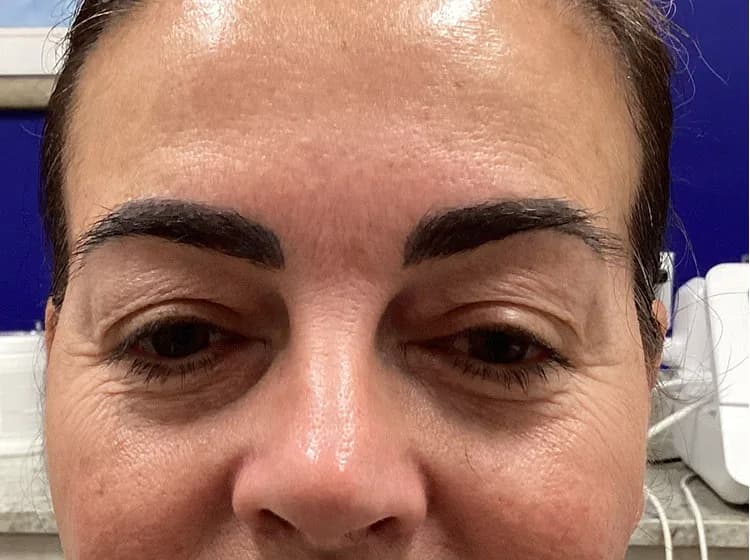 Eyebrow tattoo removal, before