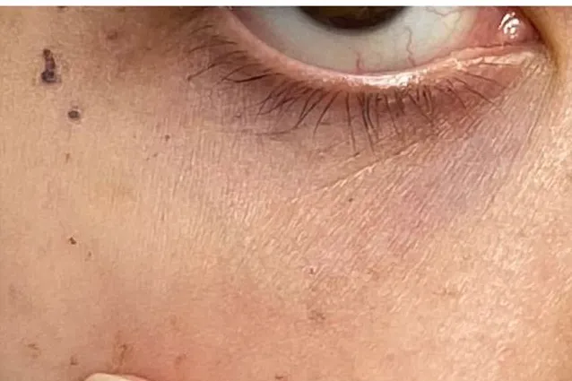 Laser vein removal, under-eye vein, after