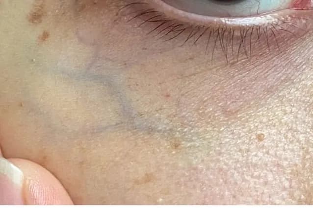 Laser vein removal, under-eye vein, before