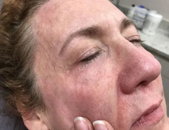 Laser vein removal, under-eye vein, oblique view, after