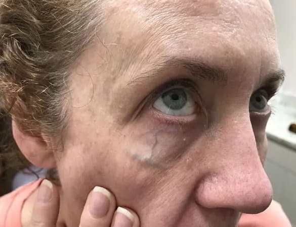 Laser vein removal, under-eye vein, oblique view, before