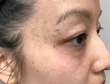 Laser treatment for facial vessels, eye area, after