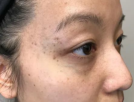 Laser treatment for facial vessels, eye area, before