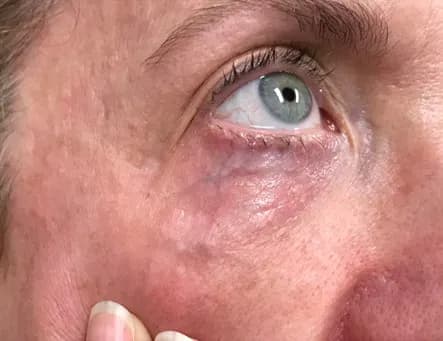 Laser treatment for under-eye veins, after