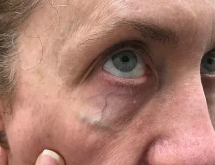 Laser treatment for under-eye veins, before