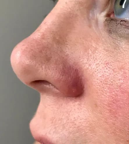 Laser treatment for vessels around the nose, after