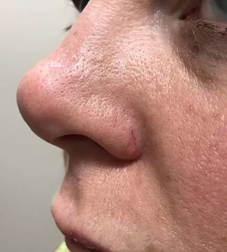 Laser treatment for vessels around the nose, before