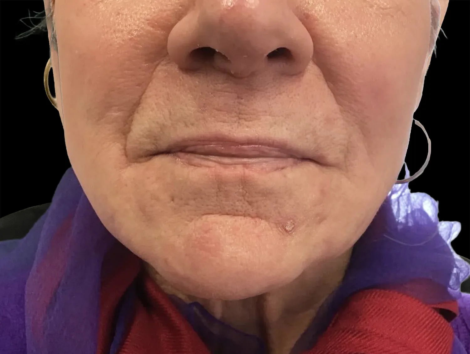 Lip vein, YAG laser, after