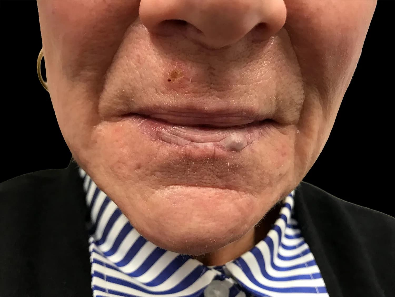 Lip vein, YAG laser, before