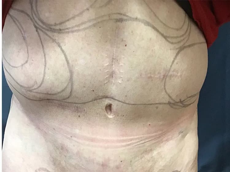 Liposuction, abdomen, before