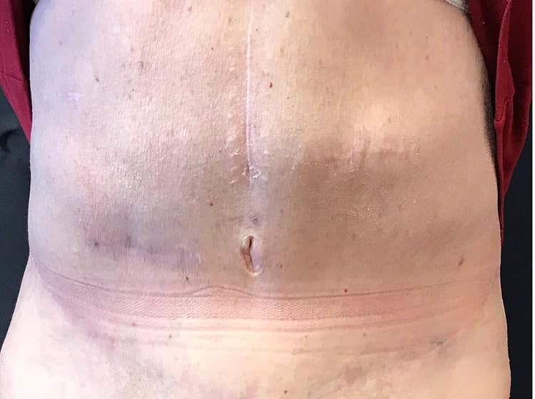 Liposuction, abdomen, after