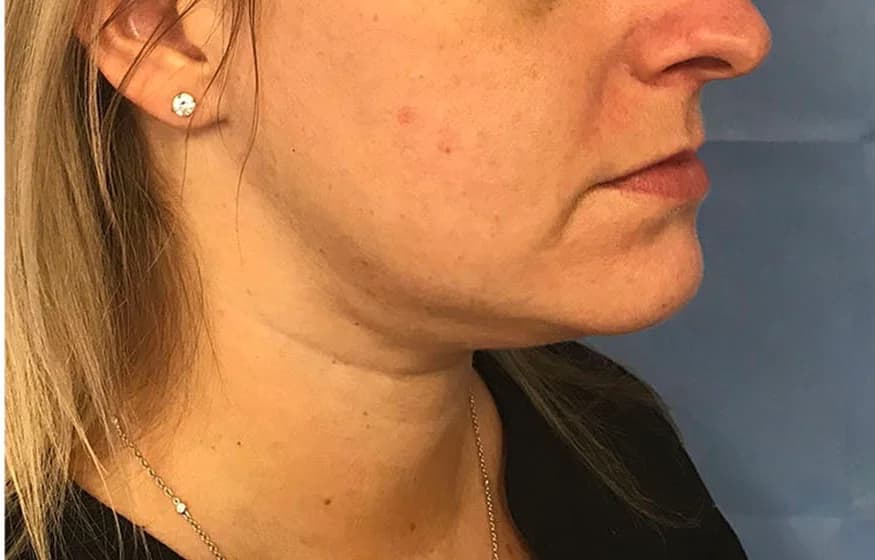 Chin and jawline liposuction, after