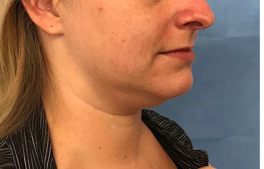 Chin and jawline liposuction, before