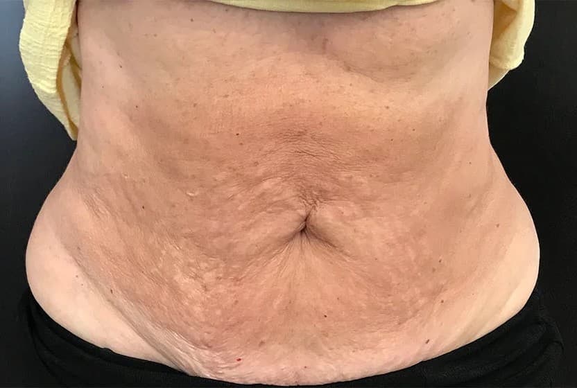 Liposuction, abdomen, after