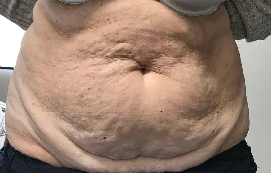 Liposuction, abdomen, before