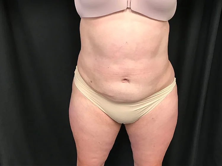 Liposuction, abdomen and flanks, after