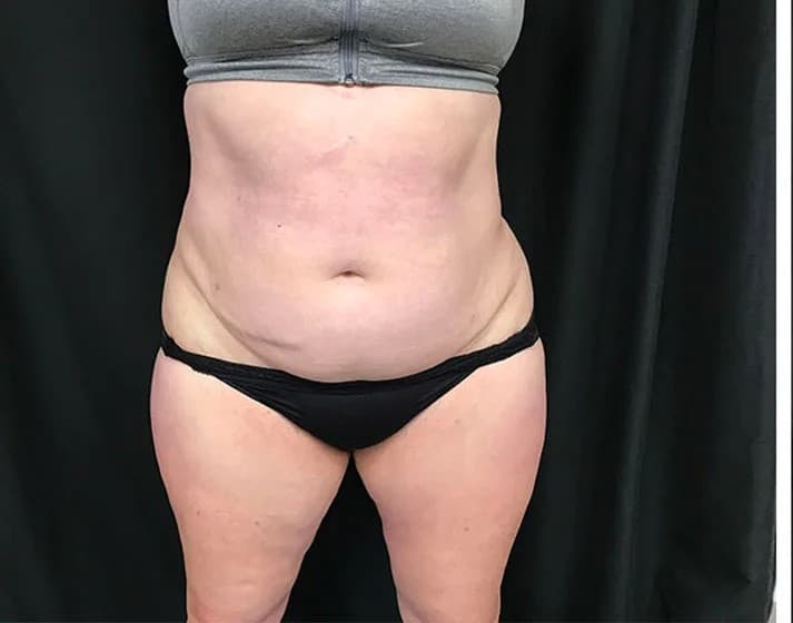 Liposuction, abdomen and flanks, before