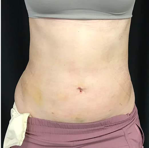 Liposuction, abdomen, after