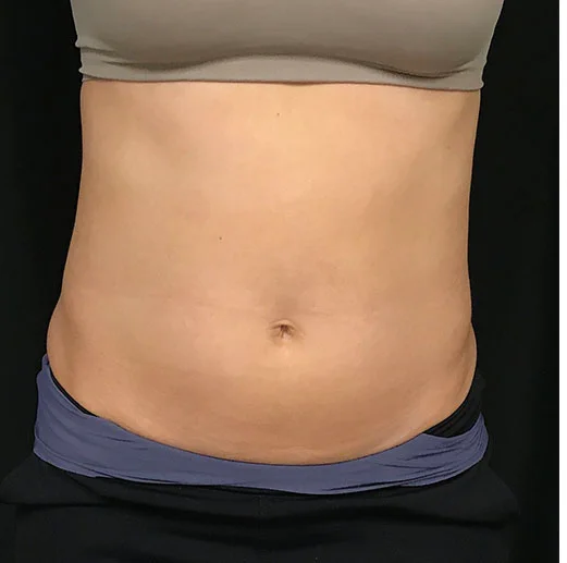 Liposuction, abdomen, before