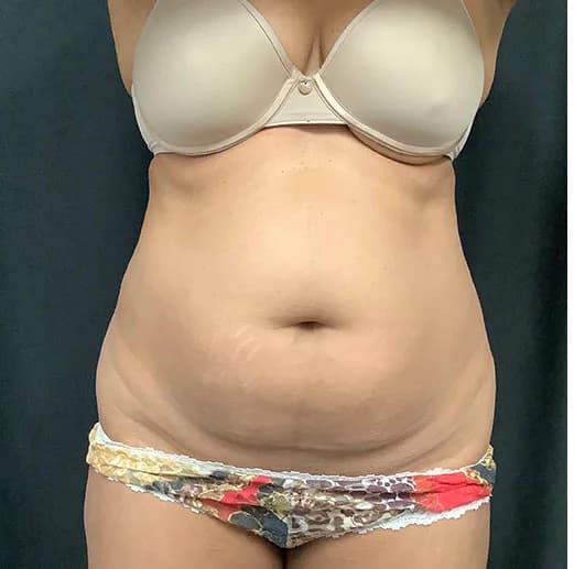 Liposuction, abdomen and waist, before