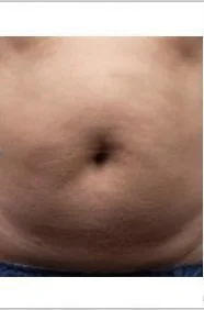 Liposonix, abdomen, after