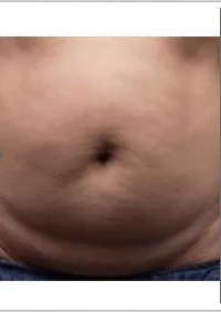 Liposonix, abdomen, before