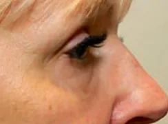 Morpheus8, under eye area, after
