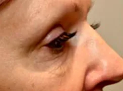 Morpheus8, under eye area, before