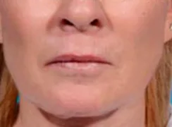 Morpheus8, lower face and jawline, after