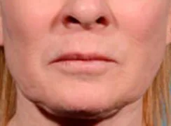 Morpheus8, lower face and jawline, before