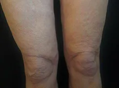 Morpheus8, thighs and knees, after
