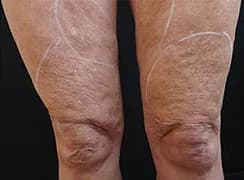 Morpheus8, thighs and knees, before