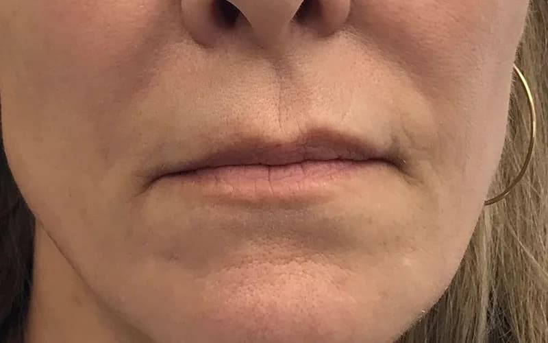 Lines around the mouth, before