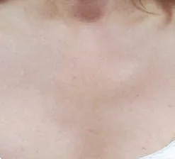 Photodynamic therapy, sun damage on the chest, after