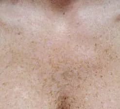 Photodynamic therapy, sun damage on the chest, before