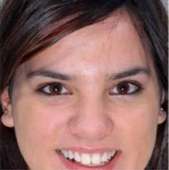 Photodynamic therapy for acne, full face, after