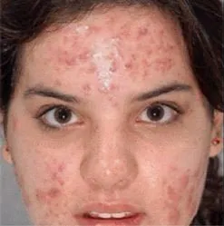 Photodynamic therapy for acne, full face, before