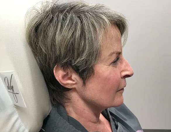ProFractional laser, side profile, after