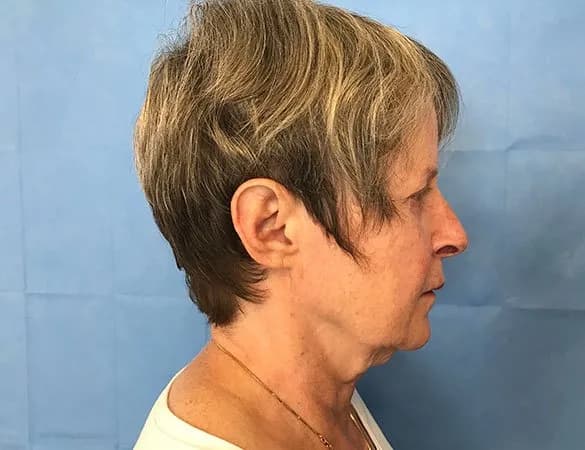 ProFractional laser, side profile, before