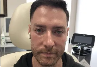 ProFractional laser, male full face, after