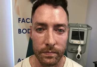 ProFractional laser, male full face, before