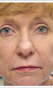 ProFractional, full face, after