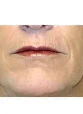 ProFractional, around the mouth, after