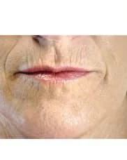 ProFractional, around the mouth, before