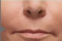 Radiesse for smile lines, after
