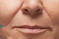 Radiesse for smile lines, before