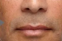 Radiesse for smile lines, male patient, after